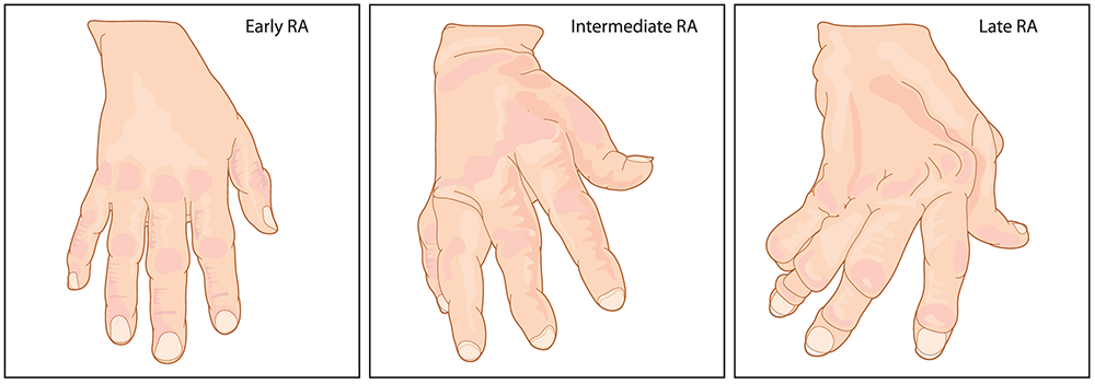 the 4 stages of rheumatoid arthritis
