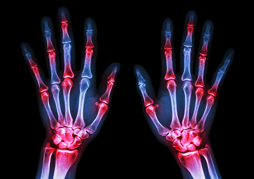 the 4 stages of rheumatoid arthritis