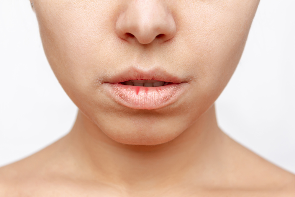 Treatment For Sjögren's Syndrome