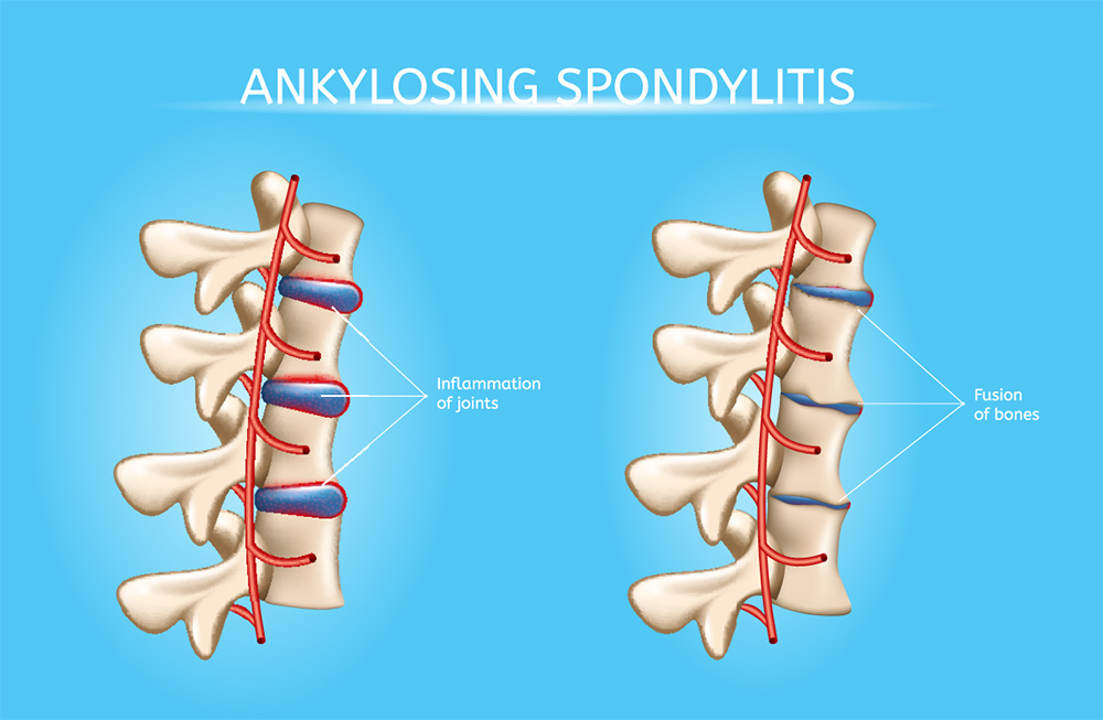 Ankylosing Spondylitis | Chronic Back Pain | Rheumatologists in Brisbane