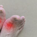 how to get rid of gout