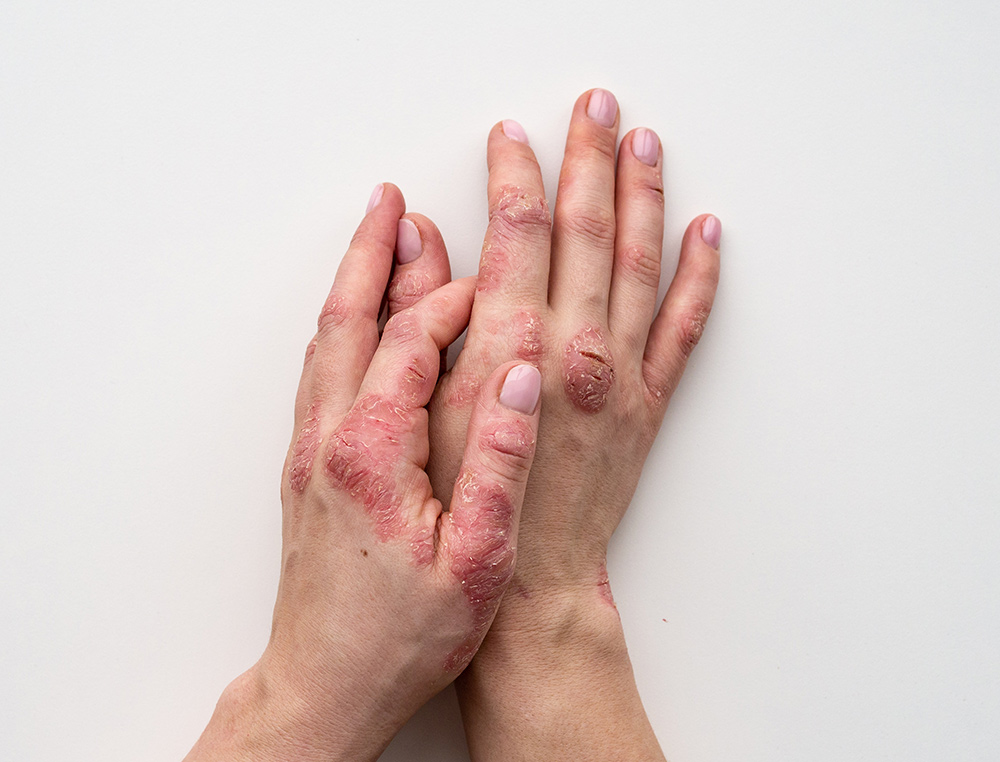 Psoriatic Arthritis and Pregnancy | Medication Safety | Healthy Pregnancy Outcomes | Rheumatologists in Brisbane